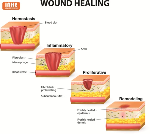 4 Stages of Wound Healing 4 Stages of Wound Healing